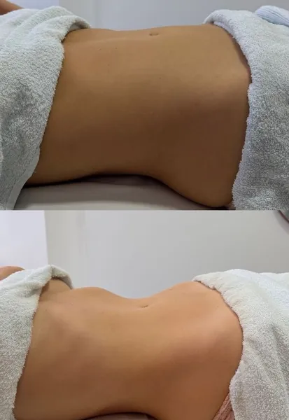 Antes e depois do abdômen desinchado com drenagem