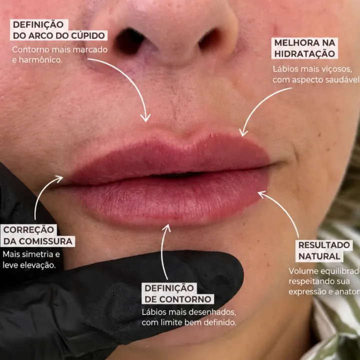 Lábios depois do preenchimento labial, com o contorno definido e aspecto natural